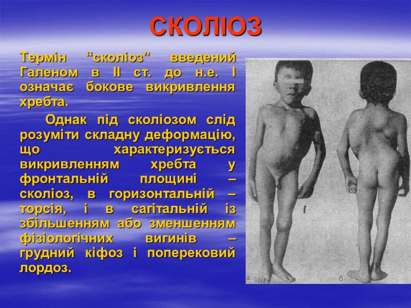 СКОЛІОЗ  Термін “сколіоз” введений Галеном в ІІ ст. до н.е. І означає бокове